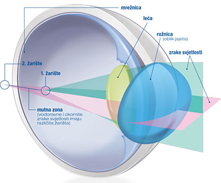 Kako izgleda astigmatizam oka